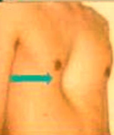 malucelli_pectus_antes03