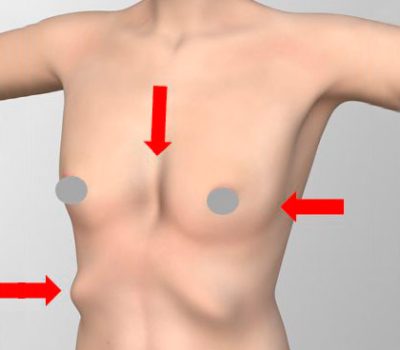 malucelli_pectus_aumentodacintura_mamaspequenas2