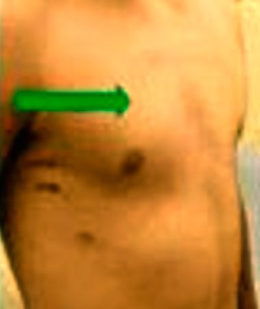 malucelli_pectus_depois02